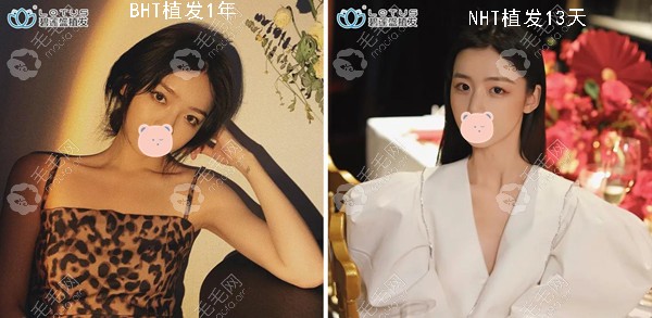 nht植发术前:发际线形状不太规则,发际线中间头发密度不够浓密.