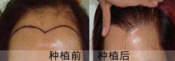 福州台江中医院毛发种植中心女性美人尖再造案例