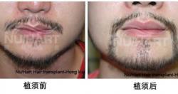 香港显赫胡须种植案例 种植胡须手术效果