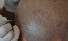 SMP头皮纹发帮你解决植发失败及无毛囊可移植的绝境