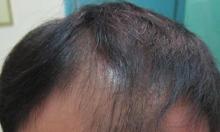 前额头发稀少怎么办 何原因导致前额脱发呢