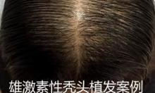 济南市中心医院皮肤科首例雄激素性秃头植发案例效果图