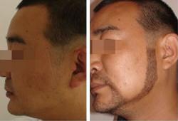 北京八大处毛发移植中心种植络腮胡须案例效果图
