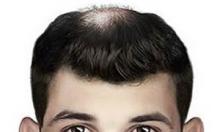 为什么脱发从头顶和发际线开始？植发还是用药物治疗好？