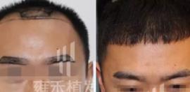 植眉效果好吗？展示北京雍禾眉毛移植效果对比图