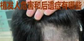 植发的危害和后遗症有哪些？毛发移植前必看宝典详细解析