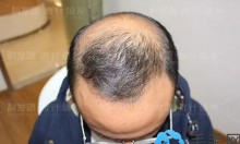 看90后的我在广州有名的植发科发源做的植发效果怎么样