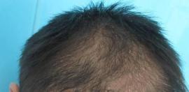 植发术后一定要用米诺地尔吗？植发后多久用米诺地尔？