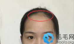 晒晒这位美女在广州种植美人尖发际线1-30天的效果图