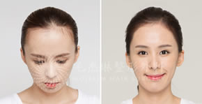韩国毛杰琳毛发移植中心女性发际线矫正案例