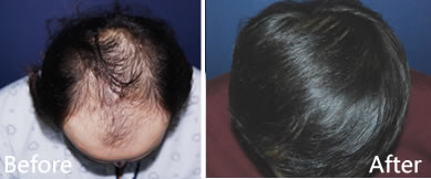 韩国多娜为大面积脱发患者实施植发手术
