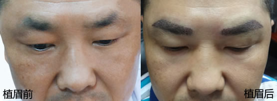 广州荔湾区人民医院毛发移植为男性植眉案例