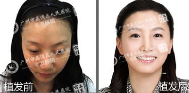 广州人民医院植发中心为女性调整发际线年轻十岁