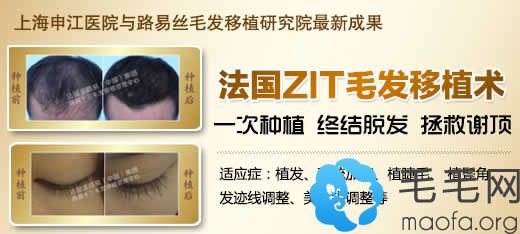 上海申江医院路易丝毛发移植中心法国ZIT毛发移植术