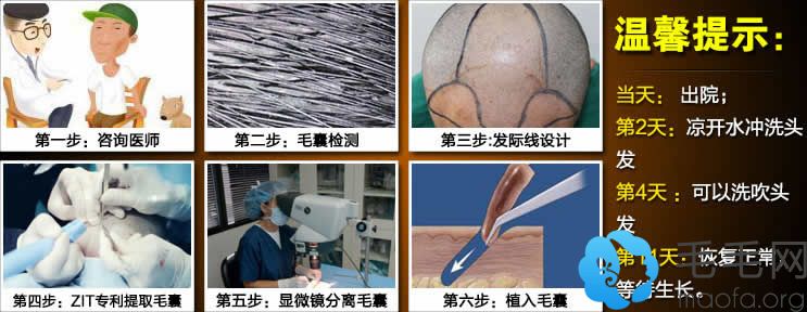 上海申江医院路易丝毛发移植中心植发手术流程