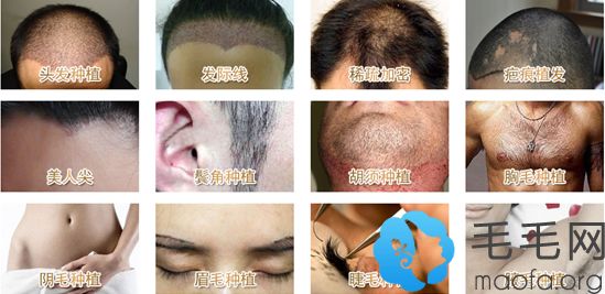 福州台江中医医院植发中心进行的毛发移植项目分类