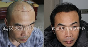 武汉天佑医院植发中心治疗脂溢性脱发5级案例