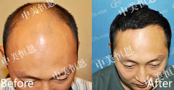 北京中美恒恩植发中心朱东方为男性患者植发