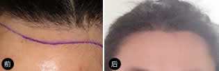 美基元医院采用M-SHT为张女生种植发际线
