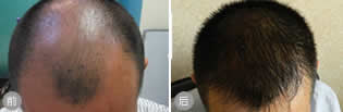 武汉美基元为五级脱发患者成功实施M-SHT植发术