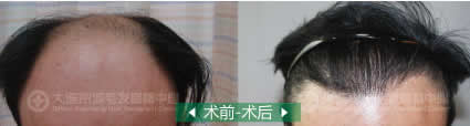 大连京城植发中心为六级严重脱发患者成功植发