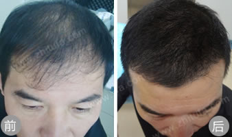郑州陇海植发案例 男性脱发患者植发手术效果
