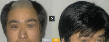 江西广济医院毛发移植案例 重塑线际线+头发加密