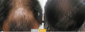 江西广济医院毛发移植案例 卷发移植+头发加密手术
