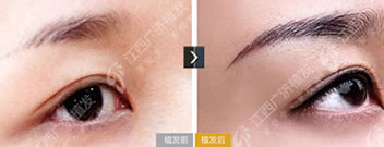 江西广济医院毛发移植案例 女性半截眉种植效果