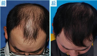杭州市人民医院植发案例 男性秃顶植发效果