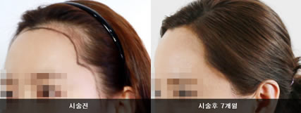毛芽满植发案例 女性发际线调整手术