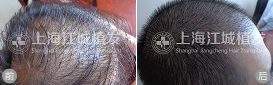 上海江城医院植发案例 植发手术治疗男性脱发