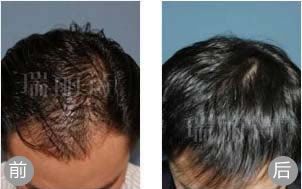 西安植发案例 PHT植发手术治疗遗传性脱发