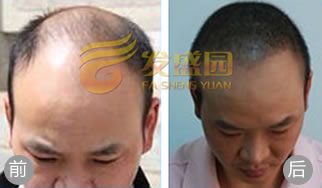 北京发盛园植发案例 严重脱发患者成功植发
