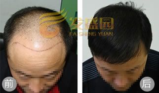 北京发盛园植发案例 六级脱发患者成功植发