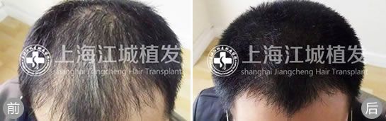 上海江城医院植发案例 头发稀疏选择植发