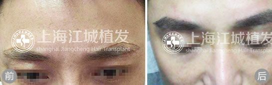 上海江城医院植发案例 男性种植眉毛效果