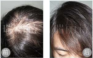 西安植发案例 PHT植发治疗女性产后脱发