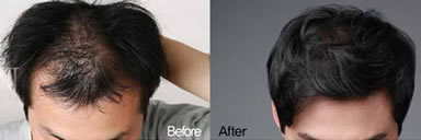 重庆欧亚毛发种植案例 男性头顶加密手术