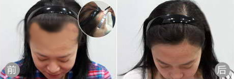 重庆欧亚毛发种植案例 女性发际线种植手术