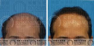 广州乐鬓植发案例男性秃顶植发手术效果