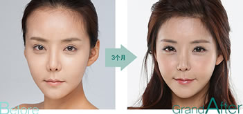 韩国高兰得植发案例 女性发际线调整脸型效果
