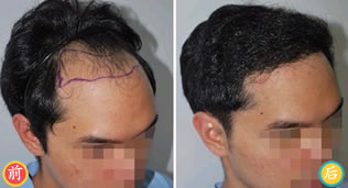 徐州有美植发案例 FUE隐痕植发治疗遗传性脱发