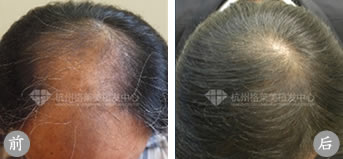 杭州格莱美植发案例 中年男性头顶脱发治疗手术