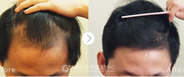 南京华美植发案例 植发治疗深M字及周边的脱发