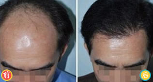 北京美莱植发案例 毛发移植术解救头顶荒漠