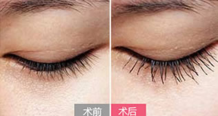 北京美莱毛发移植案例 女性种植浓密睫毛