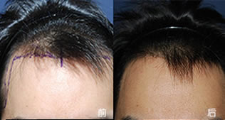 北京美莱植发案例 女性发际线种植手术