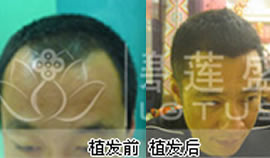 广州碧莲盛植发案例 无痕植发治疗熬夜导致脱发