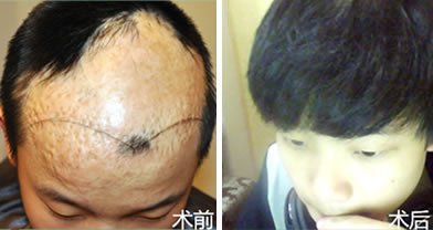 重庆重生疤痕植发案例 4D-CCS无痕植发治疗脱发